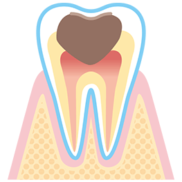 C3 神経まで進行した虫歯