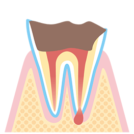 C4 根の部分だけが残った虫歯