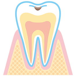C1 期の虫歯