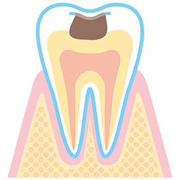 C2 歯の内部まで進行した虫歯