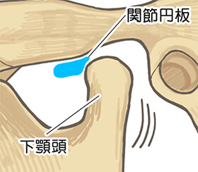 顎関節症の症状