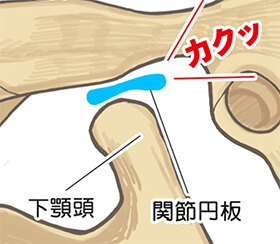 顎関節症の症状