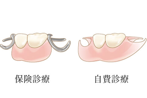 保険診療と自費診療の入れ歯の違い