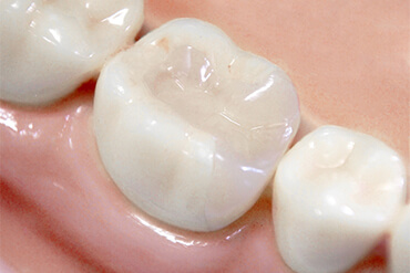 保険適用の素材（硬質レジン・金属冠・CAD/CAM冠）